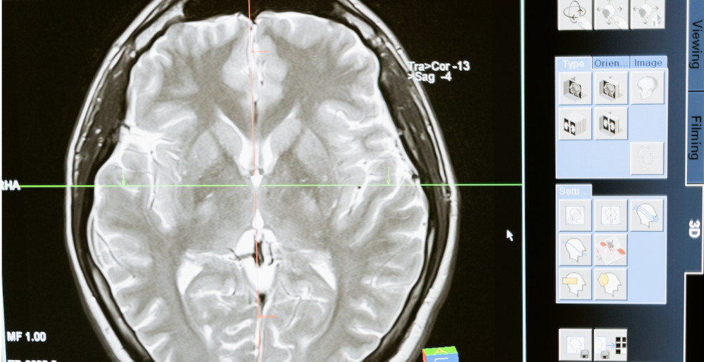 The Best Mushroom Supplement For Brain